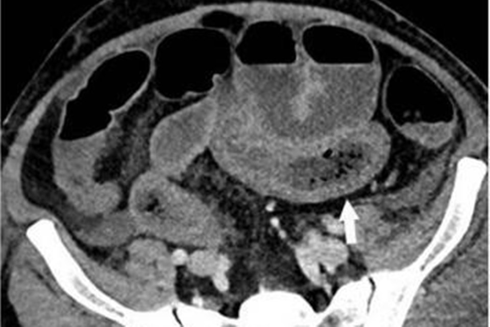 Imagem de lesões causadas no intestino pelo coronavírus
