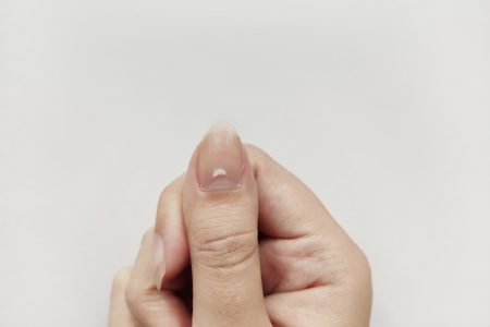 unhas com manchas brancas