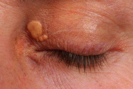 Xanthelasma