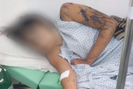 A jovem teve queimaduras de terceiro grau no rosto, couro cabeludo, braços, costas e pernas