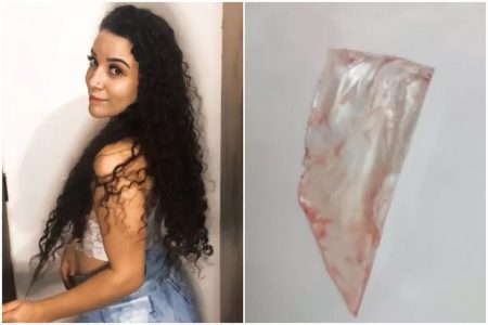 Jovem diz que foi atendida em UPA de Praia Grande e médico não viu vidro alojado nas costas
