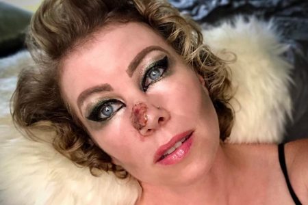 Mulher com maquiagem ao redor dos olhos, deitada, com tumor no nariz - Metrópoles