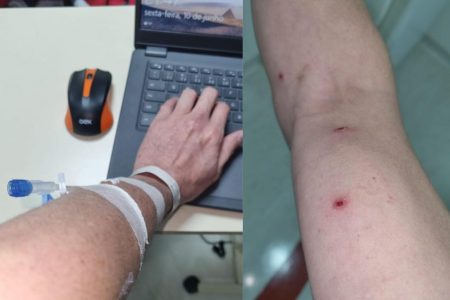 Primeiro brasileiro diagnosticado com varíola dos macacos