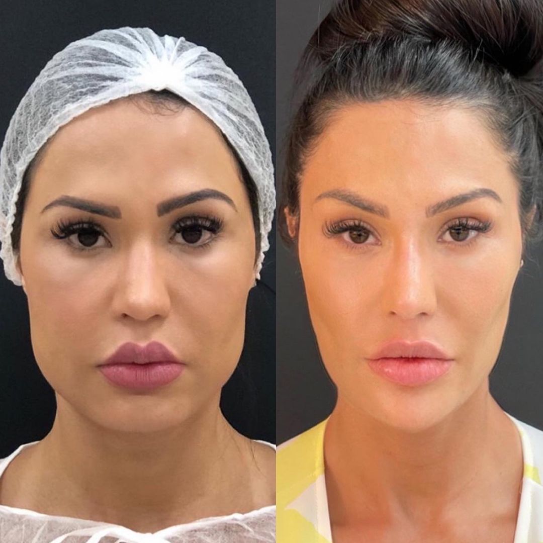 Gracyanne Barbosa - harmonização facial