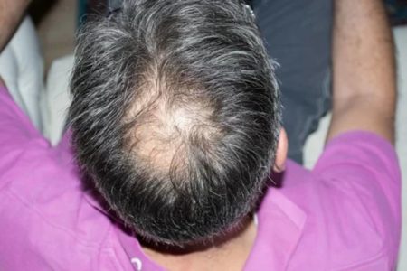 Foto colorida de pessoa careca