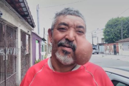homem com cisto gigante no rosto Metrópoles