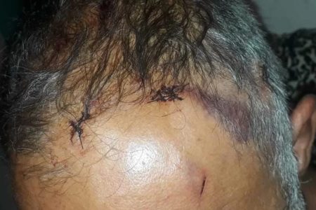 Roberto Gomes de Paulo, auxiliar de limpeza vítima de tentativa de homicídio a facadas após se negar a dar R$ 1 a pedinte. Imagem mostra pontos e hematomas na cabeça da vítima, que é parda e tem cabelos curtos, grisalhos - Metrópoles