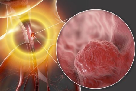 Ilustração mostra um esôfago e o zoom de uma massa cancerígena na região - Metrópoles