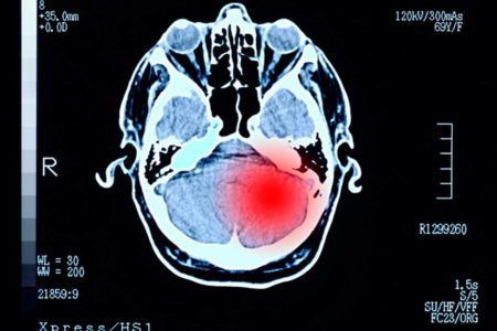 Tomografia apontando sinal vermelho no cerebro do paciente