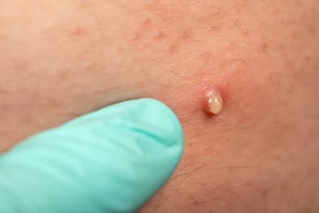 Imagem mostra dedo com luva apontando para uma foliculite na pele - Metrópoles