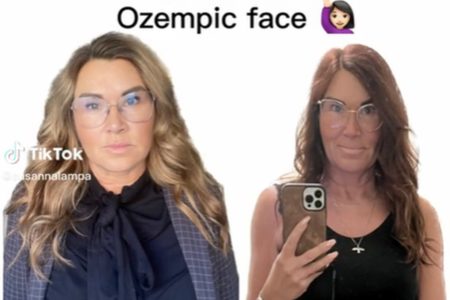 Imagem colorida de mulher mostrando os efeitos do ozempic no rosto - Metrópoles