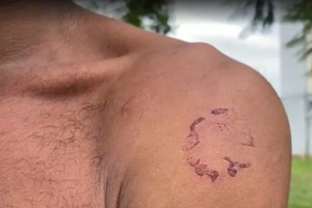 Trabalhador resgatado em vinícola mostra cicatriz - Metrópoles