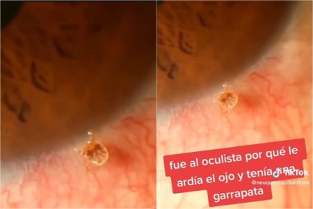 Imagem colorida: carrapato em olho de homem - Metrópoles