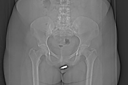 Imagem de radiografia mostra bala perdida alojada em clitóris de mulher - Metrópoles