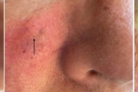Menor melanoma do mundo é identificado, tem 0,65mm, menos que um fio de cabelo - Metrópoles