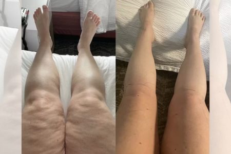 Imagem colorida: antes e depois de pernas de mulher com lipedema - Metrópoles