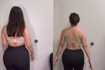 Bumbum de Ozempic: TikTok alerta da perda de peso rápida em nova parte do corpo Depois do rosto e dos dedos de Ozempic, usuárias da rede social alegam que remédio para emagrecer lhes tirou o rebolado