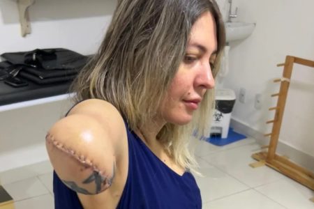 goias tatuadora braço amputado apos lipo