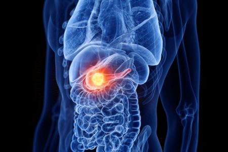 Ilustração colorida de corpo humano, com foco no pâncreas que tem uma célula cancerígena - Metrópoles