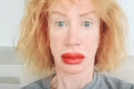 Kathy Griffin após procedimento nos lábios