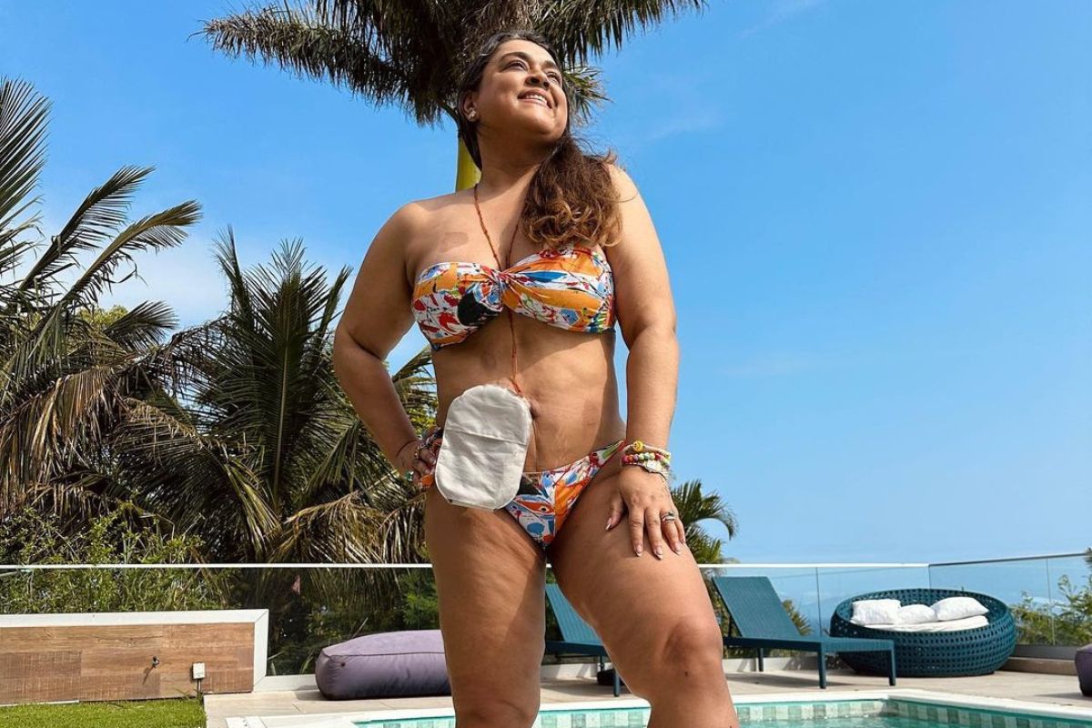 preta gil com bolsa de ileostomia