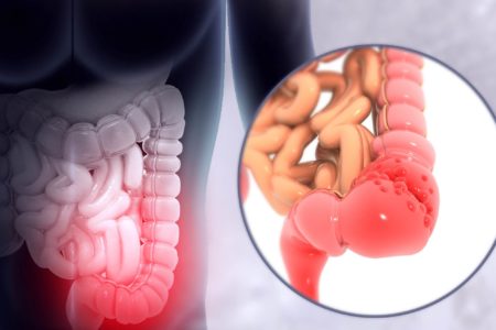 Ilustração mostra a porção final do intestino inflamada pelo câncer colorretal