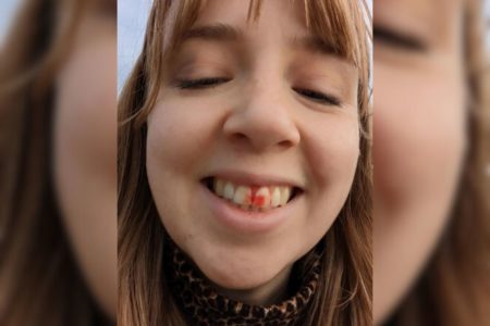 Imagem colorida de mulher sorrindo para mostrar mancha na gengiva - Metrópoles