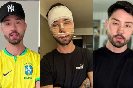 Rico Melquiades antes/ durante e depois dos procedimentos estíticos