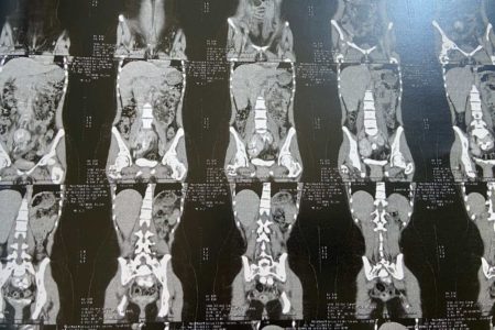 Reprodução de exames mostra mulher com Síndrome de Rokitansky