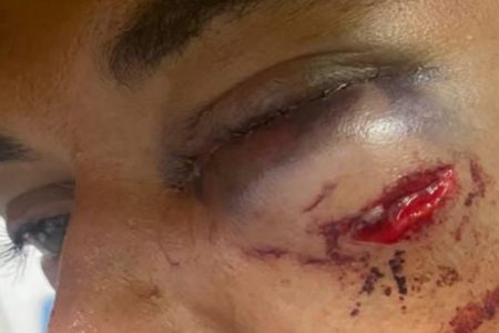 Imagem colorida mostra close de ferimento feito no rosto de um rapaz de pele parda; ele foi agredido por um PM - Metrópoles