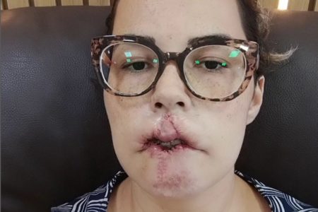 Mulher de óculos com cicatriz nos lábios - Metrópoles