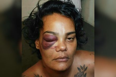 Imagem colorida de mulher com hematoma no olho direito - Metrópoles