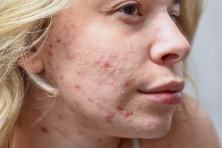 Mulher com o rosto com muita acne