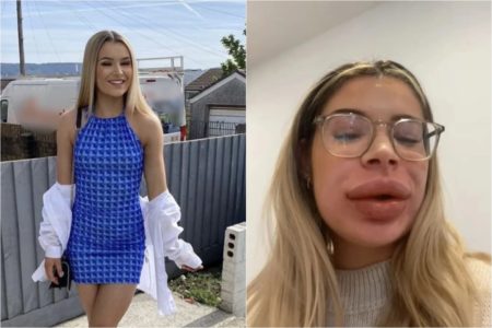 Duas fotos de mulher: uma dela sorrindo e outra com reação alérgica - Metrópoles