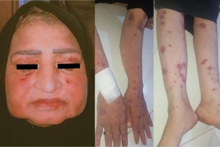 Foto mostra rosto de mulher que teve rara reação alérgica ao ibuprofeno