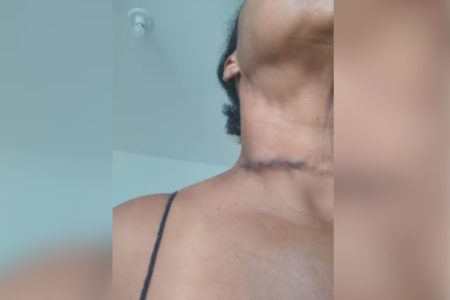 Imagem colorida mostra mulher que teve o pescoço cortado por cerol enquanto andava de bicicleta - Metrópoles