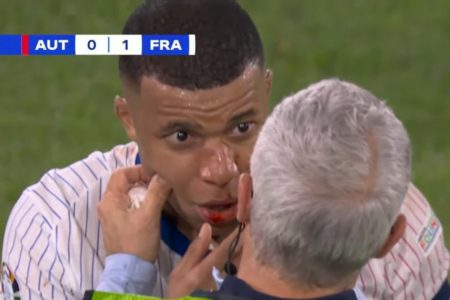 Imagem colorida de Mbappé com o nariz quebrado - Metrópoles