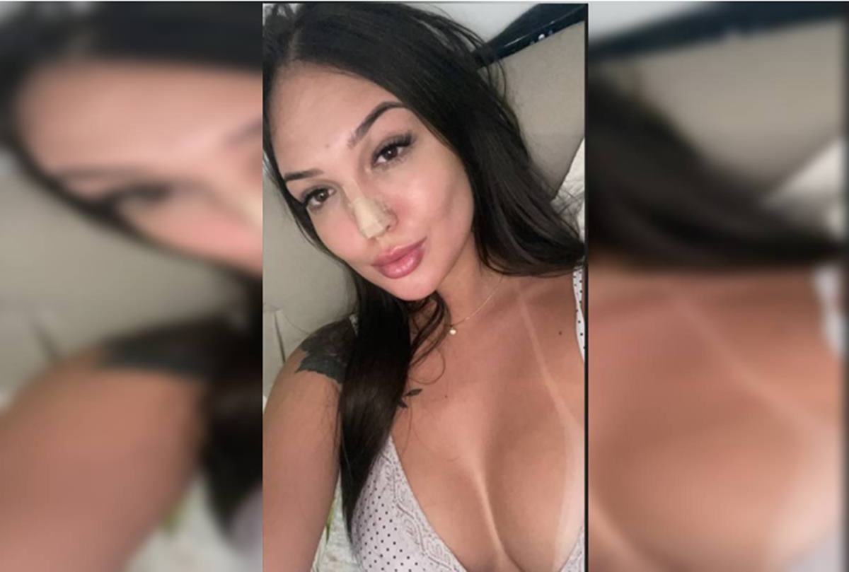 Mulher com nariz operado