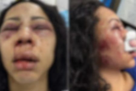 imagem colorida. Turista brasileira com rosto inchado após agressão