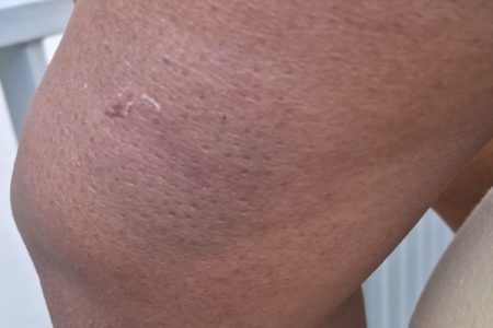 Imagem colirida mostra machucado roxo de mulher após possível agressão contra voluntária no Sacomã - Metrópoles