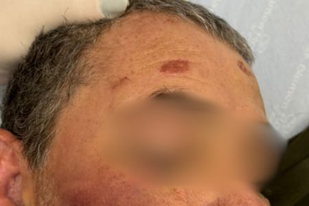 Imagem de testa ferida com hematomas - Metrópoles