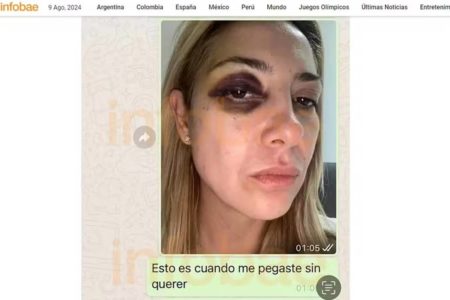 imagem colorida fabiola yanez mostra hematomas