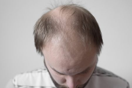 Foto de stock de Jovem inclinando-se para mostrar calvície cabeça