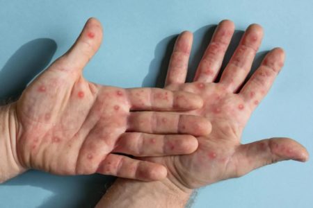 mpox lesões