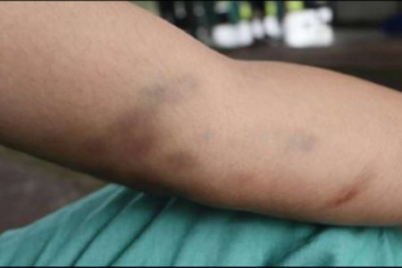Foto de braço com marcas roxas