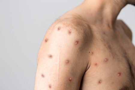 Homem de perfil com feridas da mpox rio de janeiro - Metrópoles