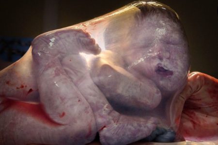Foto colorida de um bebê empelicado - Metrópoles