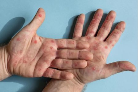 Secretaria de Estado da Saúde de São Paulo confirmou 533 casos de mpox de janeiro até o dia 9 de setembro - Metrópoles