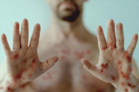 Foto de homem mostrando as mãos com lesões na pele - Metrópoles