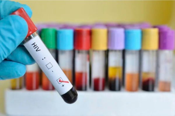 Foto mostra teste do HIV positivo